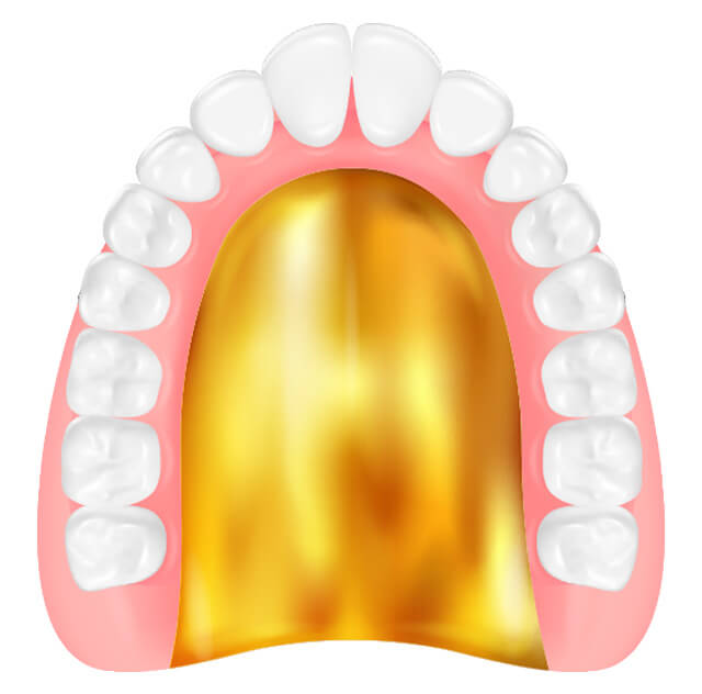 ゴールド床義歯のイラスト