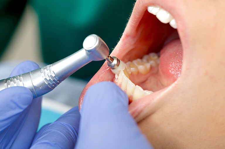 ①予防歯科とは